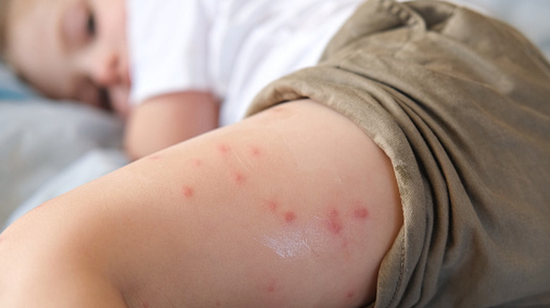 A young child lies on a soft surface with their leg in the foreground, covered in red bumps and skin irritation